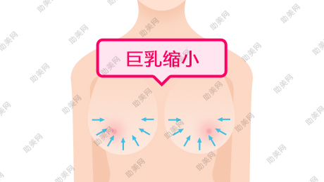 昭通胸部假体取出的价格是多少