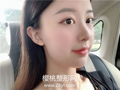 郑州缔莱美杨胜发双眼皮真人案例+2021最新价格表一览