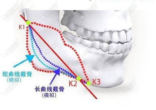 赵绛波下颌角技术可信