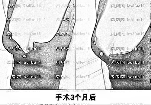 西安高一生医疗美容医院张林宏自体脂肪移植丰胸介绍