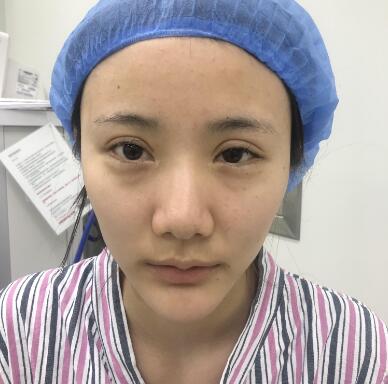 郑州华领医疗美容医院鼻部整形各种鼻形如何隆鼻，挑医生看案例看些什么