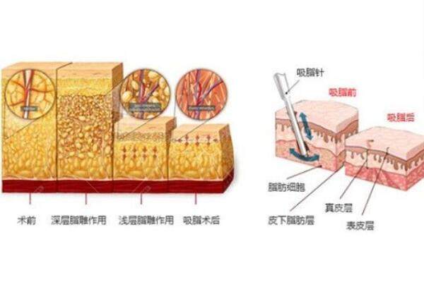 土麦森吸脂是什么原理