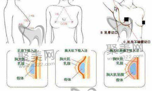 隆胸手术