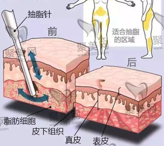 抽脂肪20斤对身体有害吗？