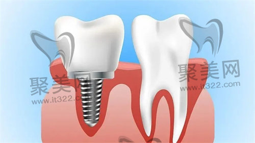种植牙