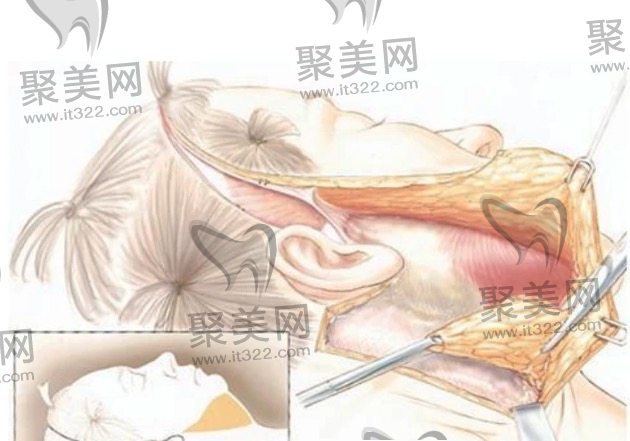 面部拉皮手术大概需要多少钱