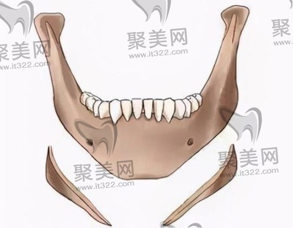 下颌角手术收费贵吗