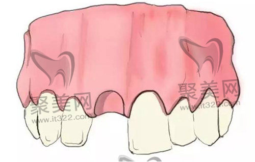 牙齿缺失