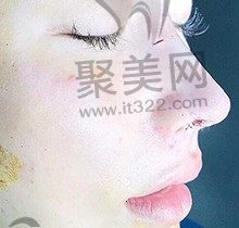 李鸿君做鼻子怎么样？量身打造妈生鼻、肋骨鼻、鼻修复口碑极好