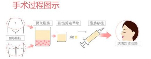 自体脂肪填充——锁住青春，留住岁月