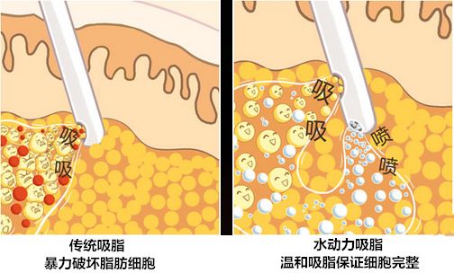 温州吸脂医院医生测评