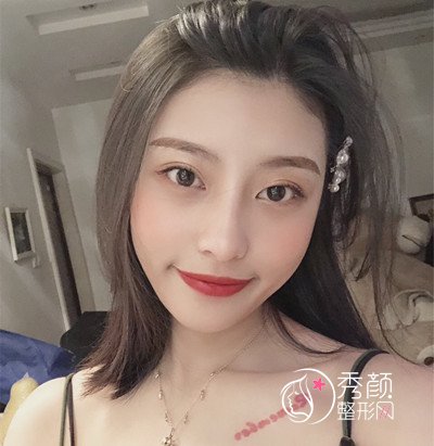 成都华美紫馨董玉林面部自体脂肪填充案例。