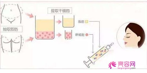 自体脂肪填充后遗症有哪些？要怎么避免这些情况呢？面部填充案例