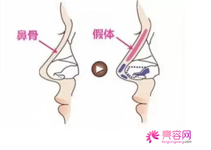 鼻部手术和眼部手术要多少钱？快来看都有哪些影响因素吧