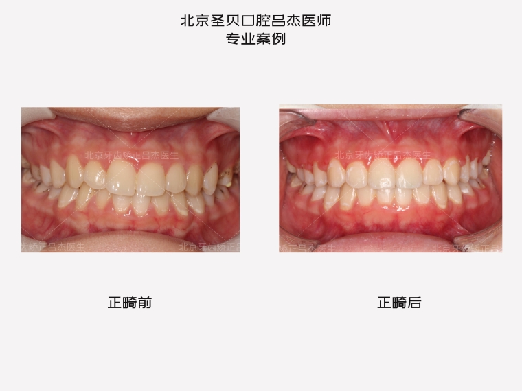 小编告诉你深圳整牙需要多少钱