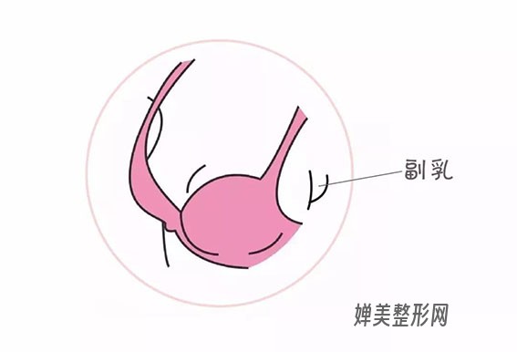 副乳需要切除吗？副乳切除手术效果好不好？