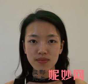 北京美莱医疗美容叶宇医生做眼部多项怎么样？真人案例对比图分享！