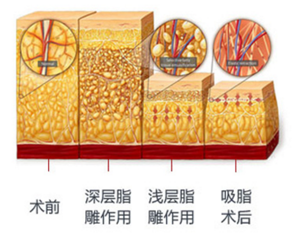 沈阳杏林整容医院：突破传统，重新定义吸脂技术