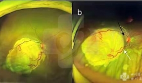 多学科联合完成首例视网膜母细胞瘤超选眼动脉介入灌注化疗
