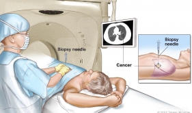 CT引导下肺穿刺活检术