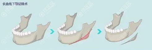 长曲线下颌角截骨示意图