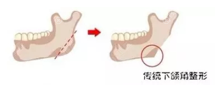 普通下颌角示意图