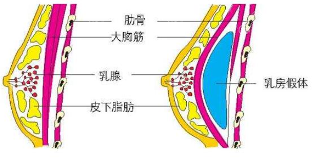 假体隆胸示意图