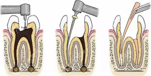 根管治疗示意图